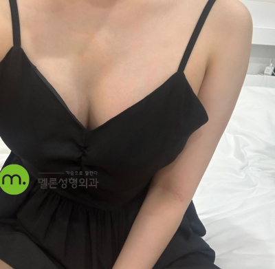 Отзыв о маммопластике Mentor Xtra в Melon Plastic Surgery 🍈