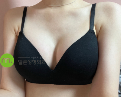 가슴성형은? 여의사가 수술하는 멜론성형외과!