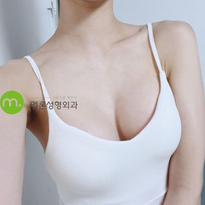 가슴성형 후 운동?! 필라테스 강사의 가슴수술 후기