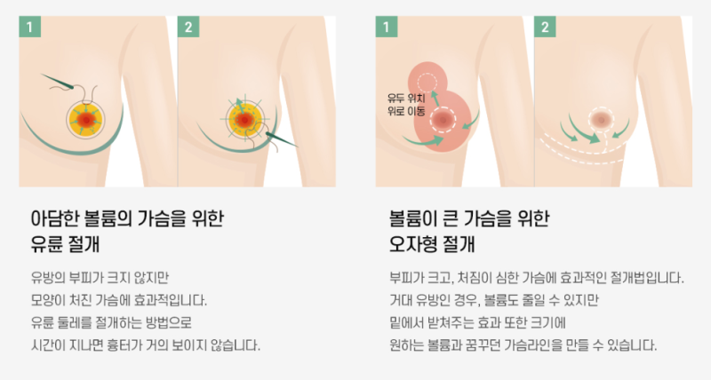 가슴거상수술, 처짐 개선 어느 정도 가능할까?
