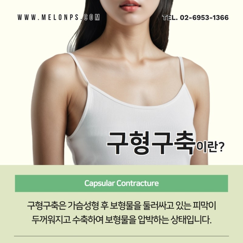 모티바 가슴 구형구축 증상? 약으로 치료?