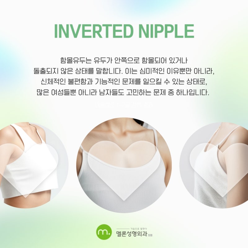 女性乳头内陷医院 - 从原因到分阶段回顾及手术费用