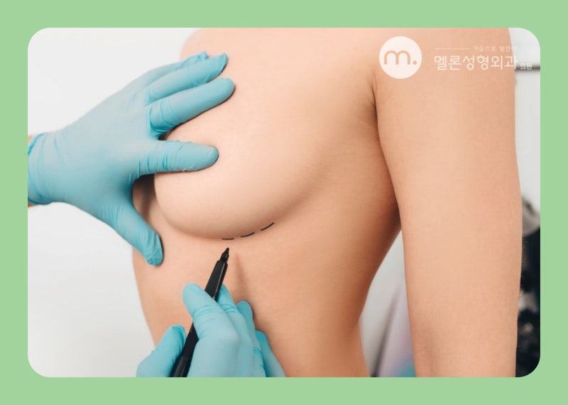 隆乳手術切口方式整理 - 乳下緣、腋下、乳暈切口
