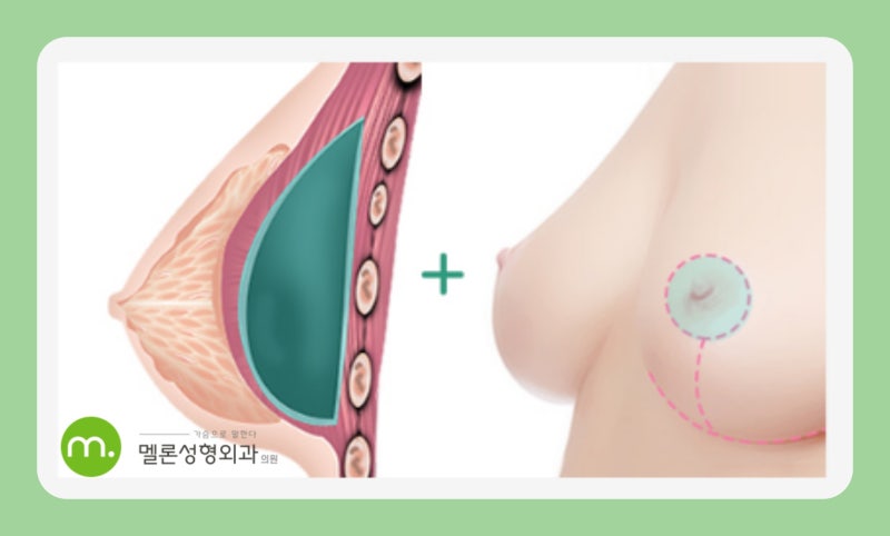 Nguyên nhân và phân tích sa trễ ngực, nếu bạn đang cân nhắc phẫu thuật thì hãy xem qua