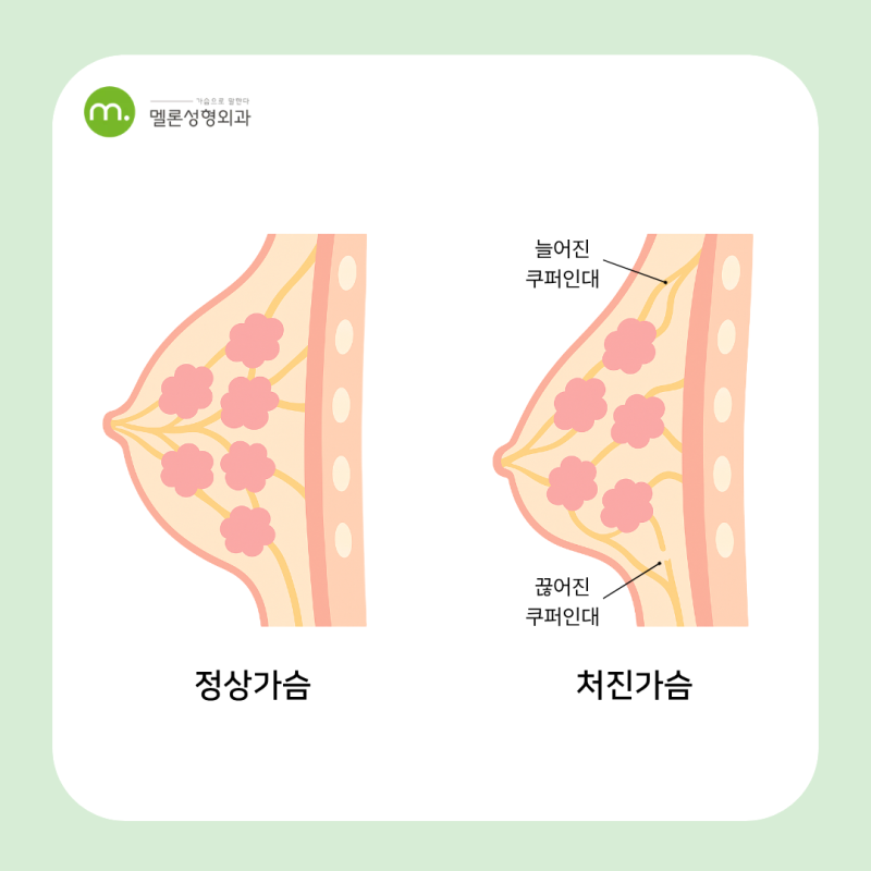 윗가슴 꺼짐 원인과 운동 해결 방법 꿀팁!