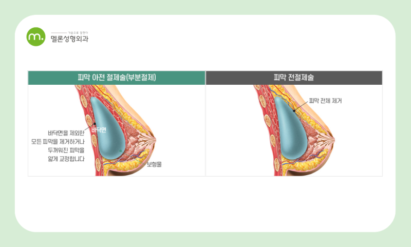 江南站隆胸修复手术,解决副作用原因、不对称、包膜挛缩、水波纹问题