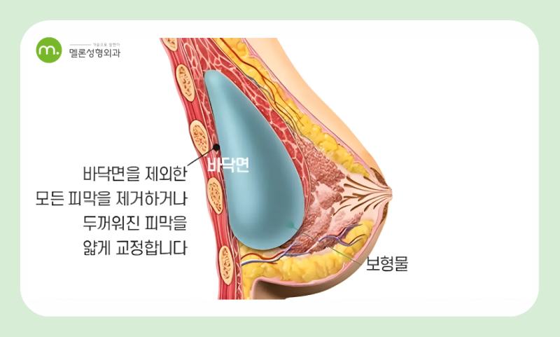 강남역 가슴재수술 잘하는 곳? 시기부터 회복기간까지 A to Z