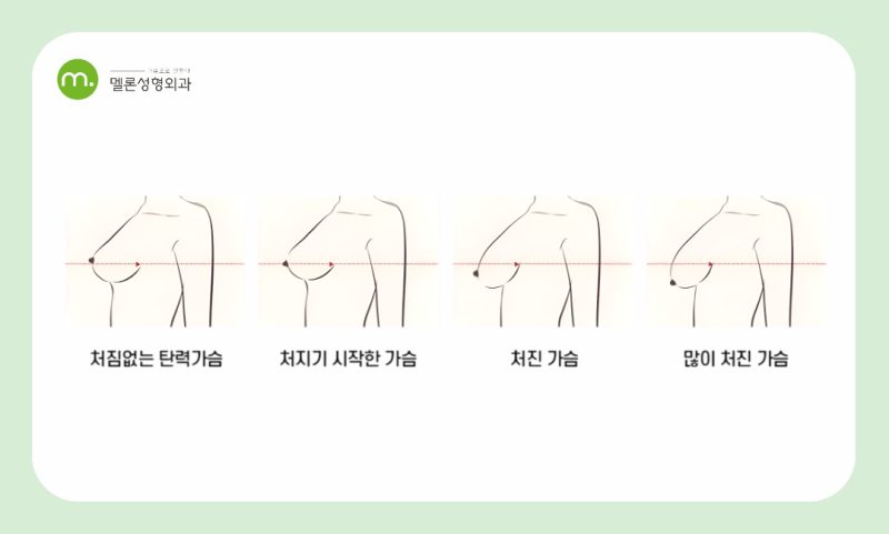 강남역 가슴거상술, 처짐을 개선하는 방법과 회복기간, 흉터 관리는?