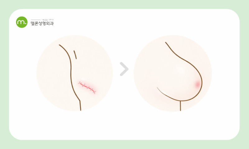 강남역 유방재건술, 장단점과 시기, 후 관리까지 총정리!