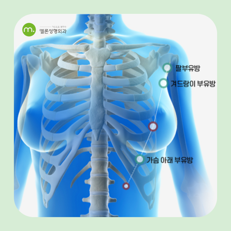 강남 부유방 제거 수술, 겨울이 적기? 방법과 흉터 회복 살펴보기