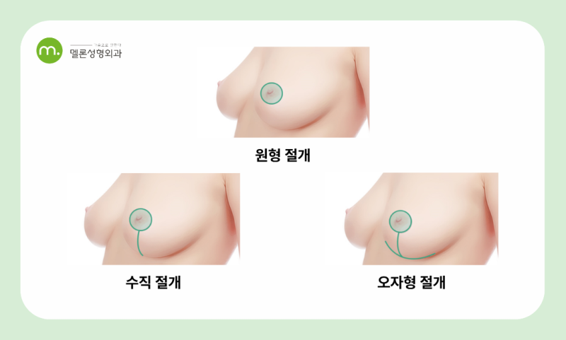 강남역 가슴축소수술, 통증과 흉터, 부작용을 줄이는 후 관리는?