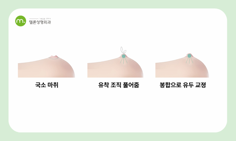 강남역 함몰유두 교정 수술가격, 후기보다 중요한 '이것'에 주목하세요