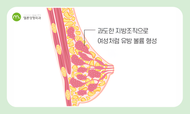 강남 남자여유증, 운동으로 안된다면? 수술 비용·통증·흉터 관리 총정리