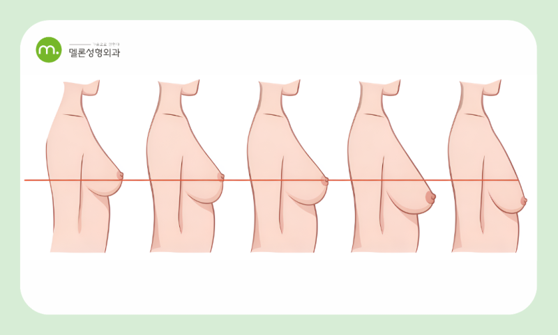 강남 가슴 재수술, 중년의 가슴 재수술은 무엇이 다를까요?