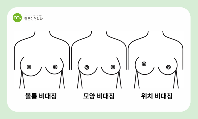 강남역 유방재건 재수술, 유방재건 후 재수술, 삼수술. 왜 고민할까요?