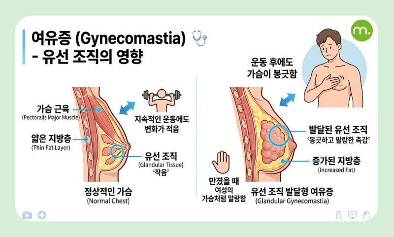 남자 여유증, 남자의 여성형 유방, 운동으로 안 된다면