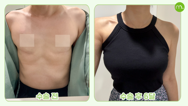 유방 전절제 후 재건 I 모티바 보형물의 지연재건 사례