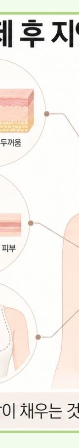 유방 전절제 후 재건 I 모티바 보형물의 지연재건 사례 사진 13