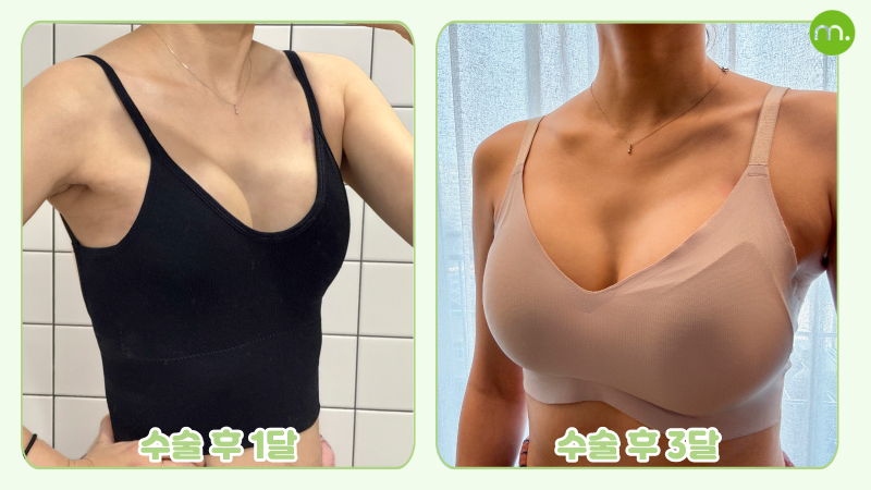 유방 전절제 후 재건 I 모티바 보형물의 지연재건 사례 사진 5