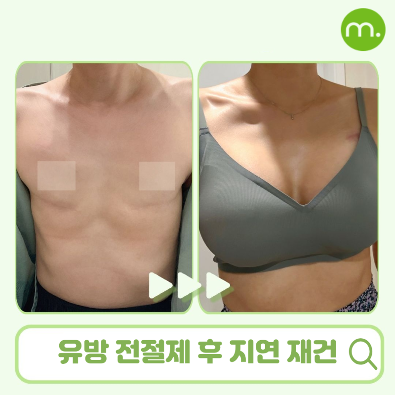 유방 전절제 후 재건 I 모티바 보형물의 지연재건 사례